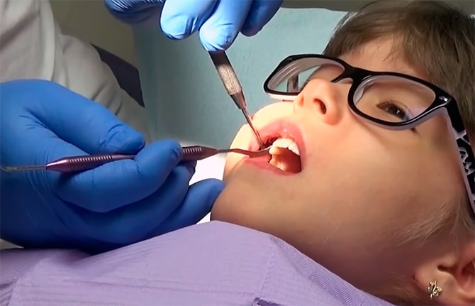 удаление зубов у детей калининград