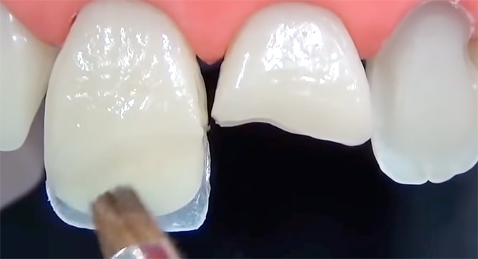 восстановление зубов калининград