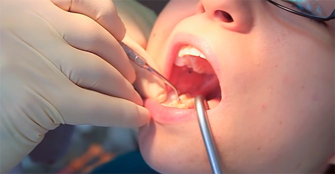пломбирование зубов у детей калининград
