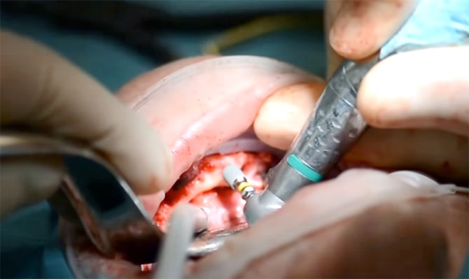 зубной имплант калининград