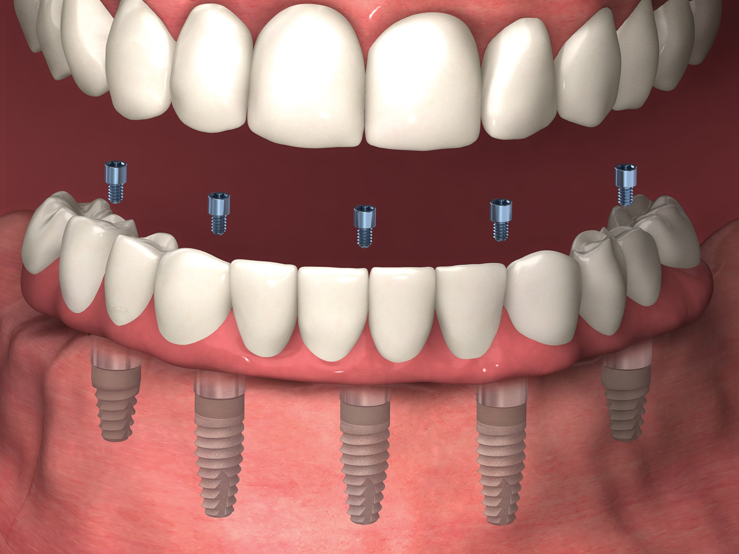 Зубные протезы и мосты