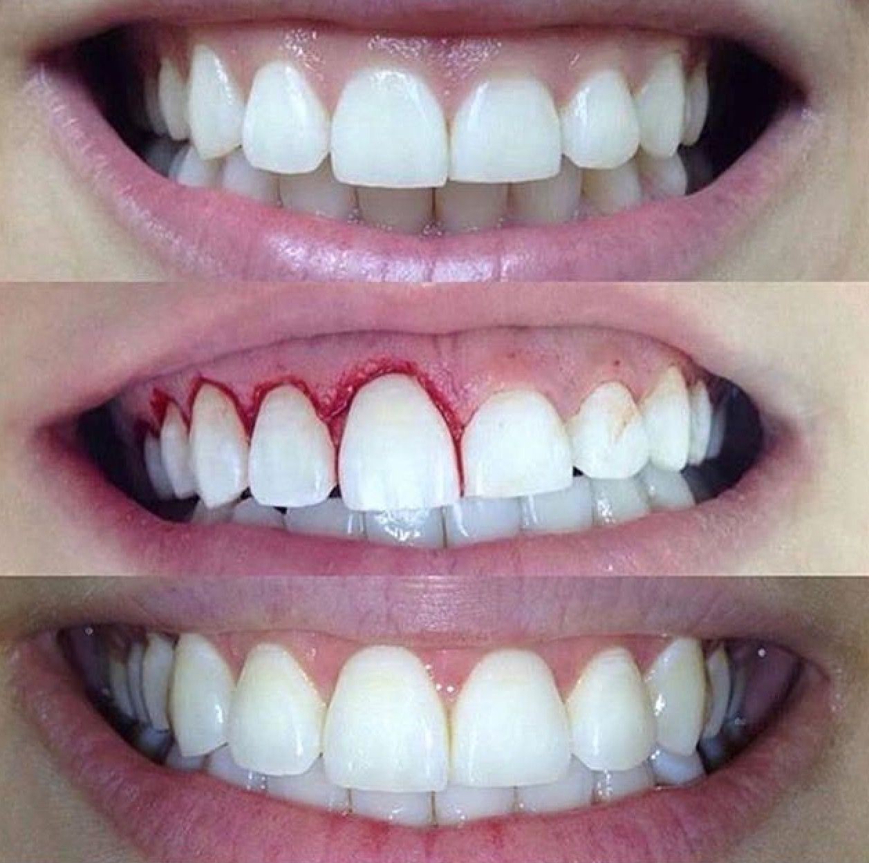Изменение формы зубов. Ровные зубы. Красивая форма зубов. Идеальные зубы.