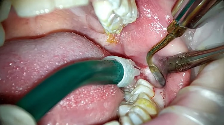 Стоматолог Галяс: когда следует удалять зуб мудрости